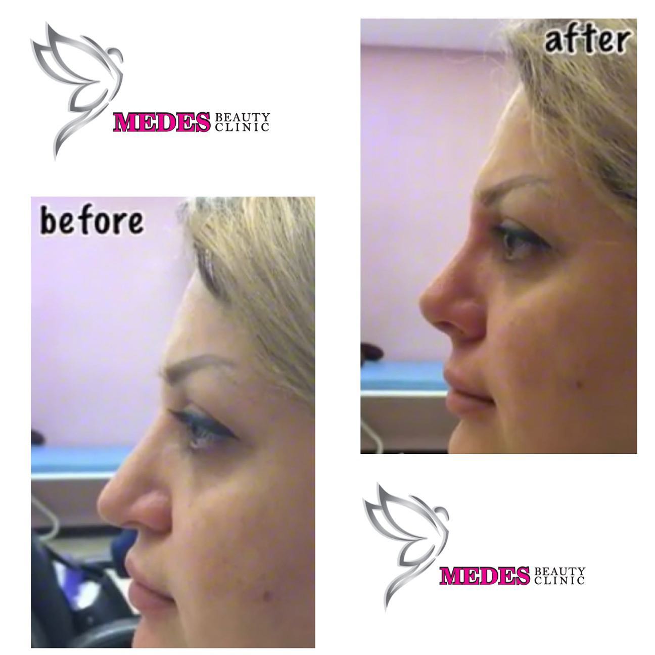 گالری لیفت با نخ